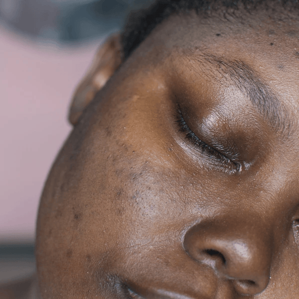 Dark Spots & Discoloration